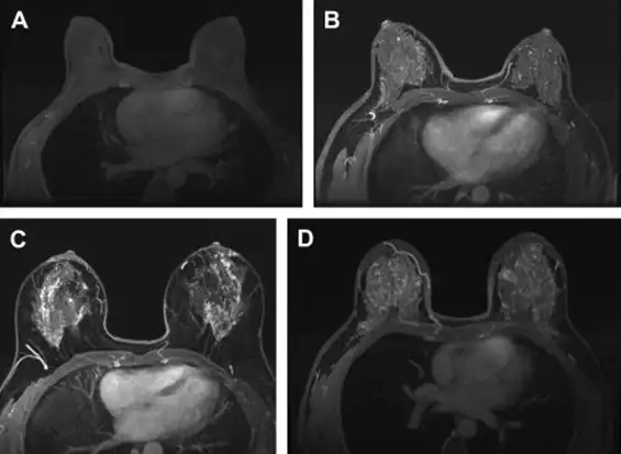 MRI images of breast cancer
