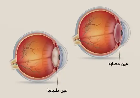 عين مصابة وعين طبيعية