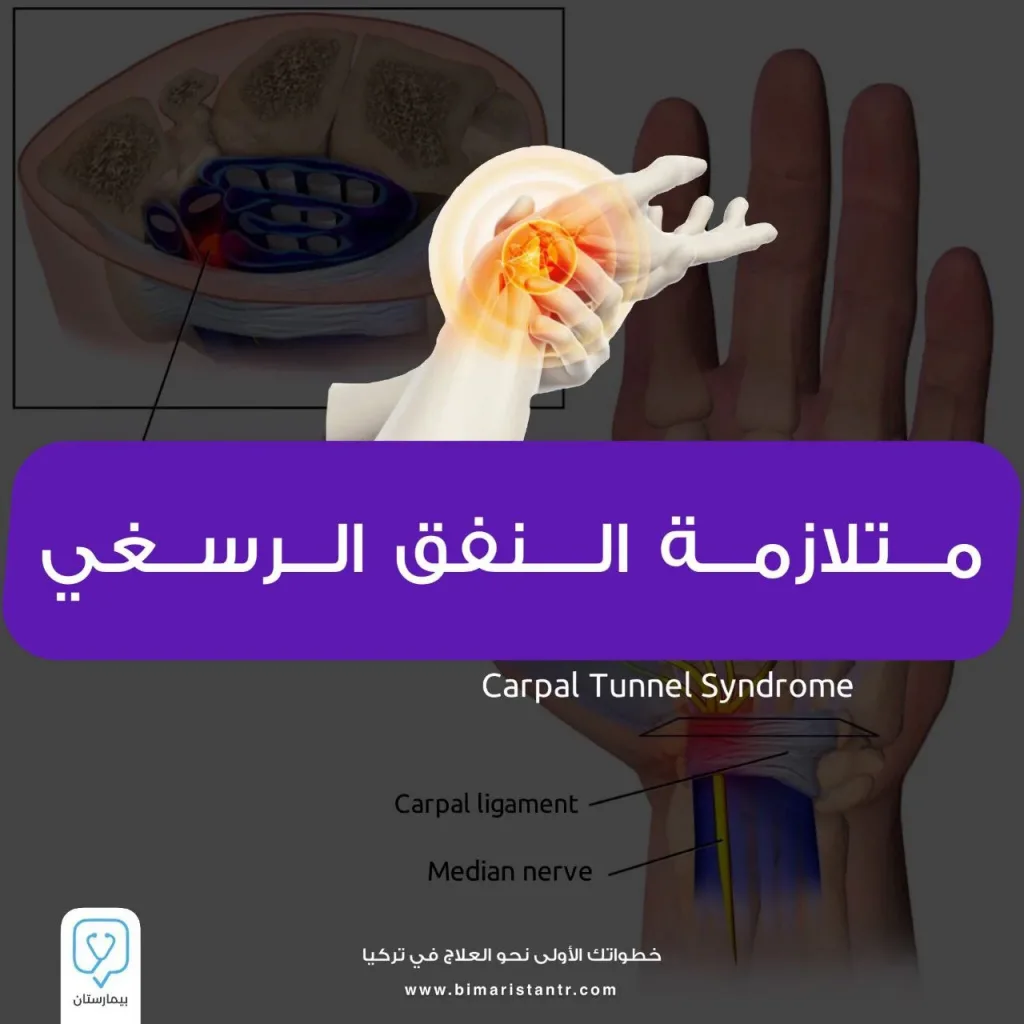 علاج متلازمة النفق الرسغي في تركيا