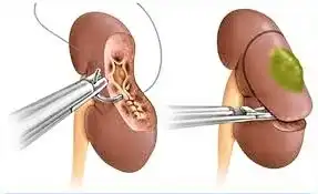 Picture showing partial nephrectomy to treat kidney cancer