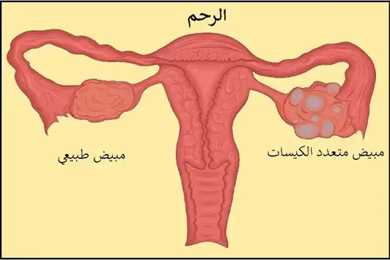 A picture of the female reproductive system and what the ovary looks like when several cysts are formed in it