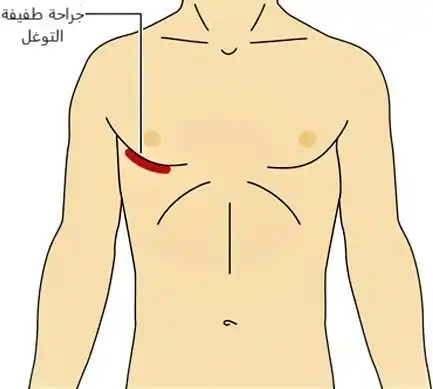Image showing the location and shape of the scar after minimally invasive coronary artery bypass surgery