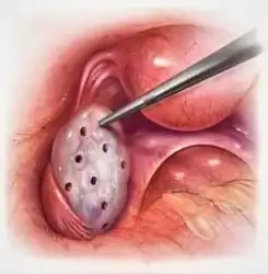 Picture showing ovarian perforation to treat polycystic ovary syndrome