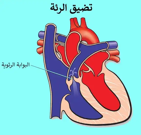 صورة توضح دسامات القلب وتضيق الدسام الرئوي في رباعي فالوت