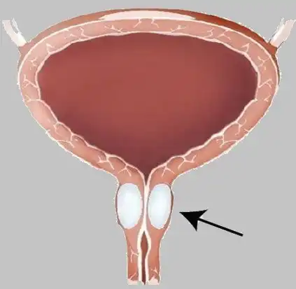 A thickening material such as silicone is injected to keep the urinary tract closed