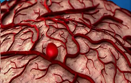 صورة تبين تمدد الأوعية الدموية وانتباجها في الدماغ