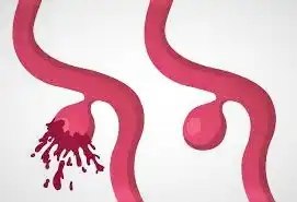 An image showing aneurysms and their ruptures in some cases