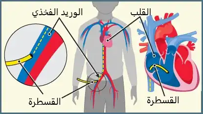 يدخل الطبيب القسطرة من الوريد الفخذي غالباً أو من أوردة اليد ثم إلى القلب