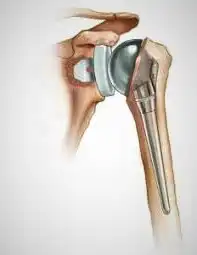 Shoulder joint replacement in Turkey