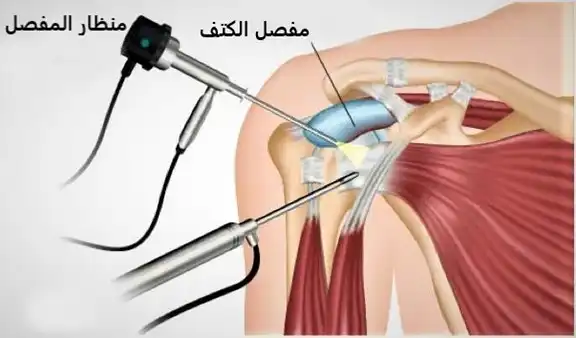 A picture of the shoulder arthroscope, where it is inserted to look for and treat problems in the shoulder joint