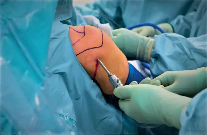 Omuz ekleminde ameliyat yapmak için artroskopi yapan bir doktorun resmi