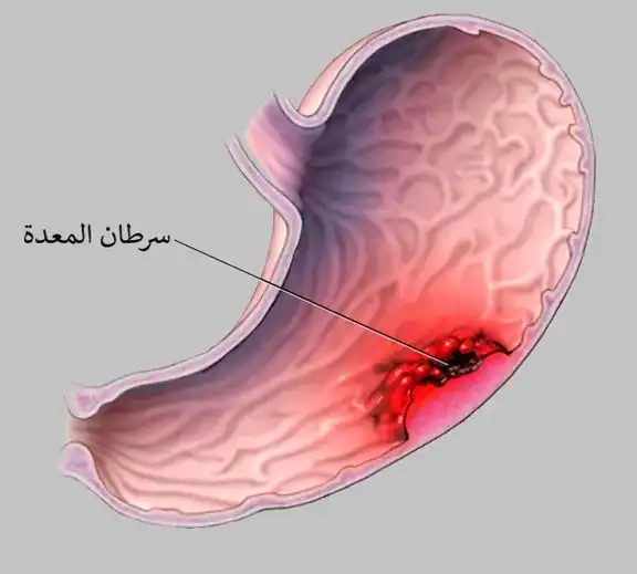 Stomach cancer is an uncontrolled proliferation of stomach lining cells that can lead to bleeding