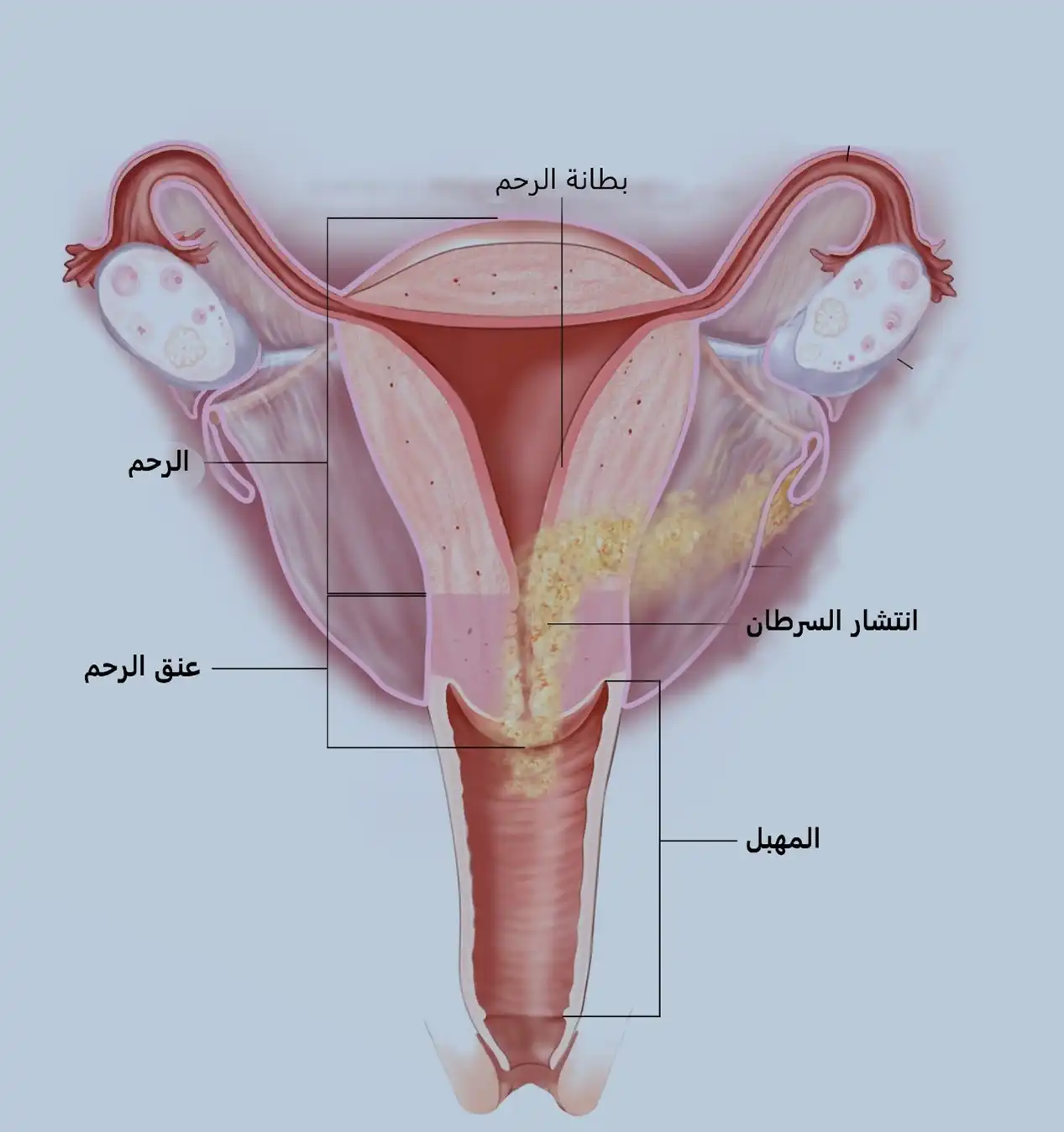 صورة تبين سرطان رحم منتشر إلى عنق الرحم