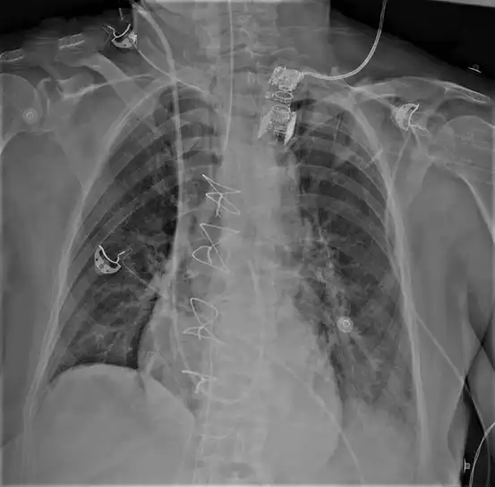 X-ray cardiac catheterization