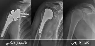 The difference between the shoulder joint after reverse replacement and the normal shoulder joint