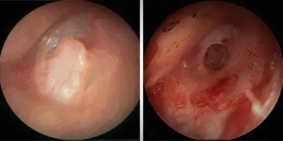 Photo of tympanoplasty and the shape of the eardrum before and after the operation