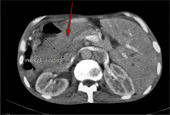 The stomach tumor is clearly visible on the CT scan