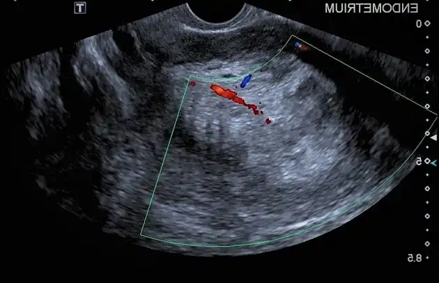 Ultrasound scan showing uterine cancer