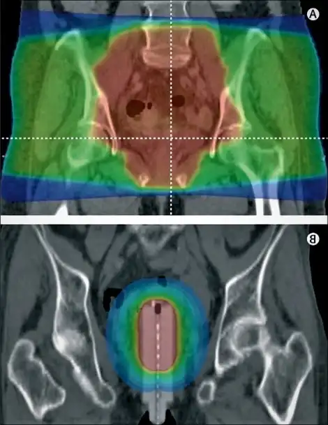 Rahim kanseri tedavisi için radyasyon odağının yerini gösteren bir radyografi