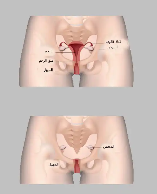 Vaginal hysterectomy with preservation of the ovaries