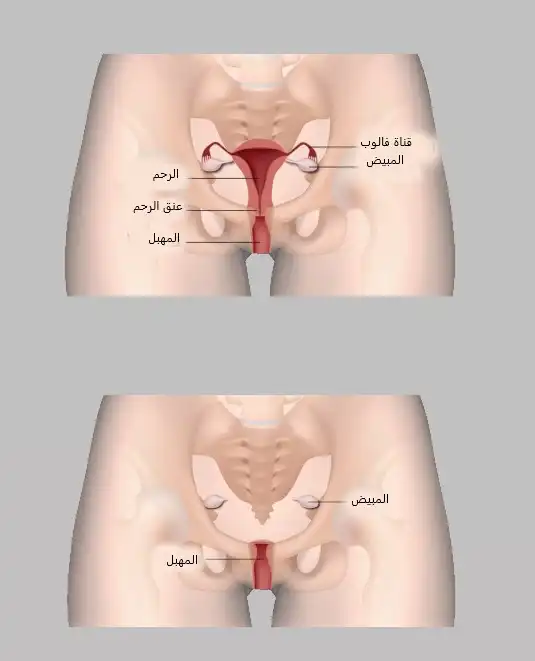 Hysterectomy while preserving the vagina and ovaries