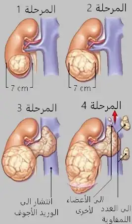 صورة تبين المراحل الأربعة لسرطان الكلى