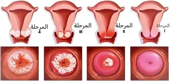صورة تبين المراحل الأربعة لسرطان عنق الرحم