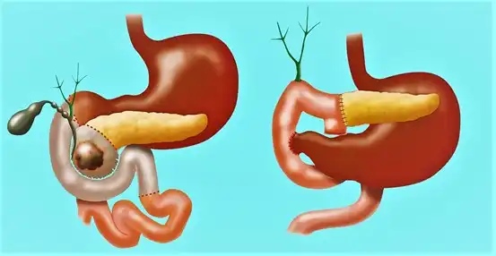 Surgery to remove the gallbladder and a section of the pancreas and duodenum