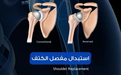 Shoulder joint replacement in Turkey