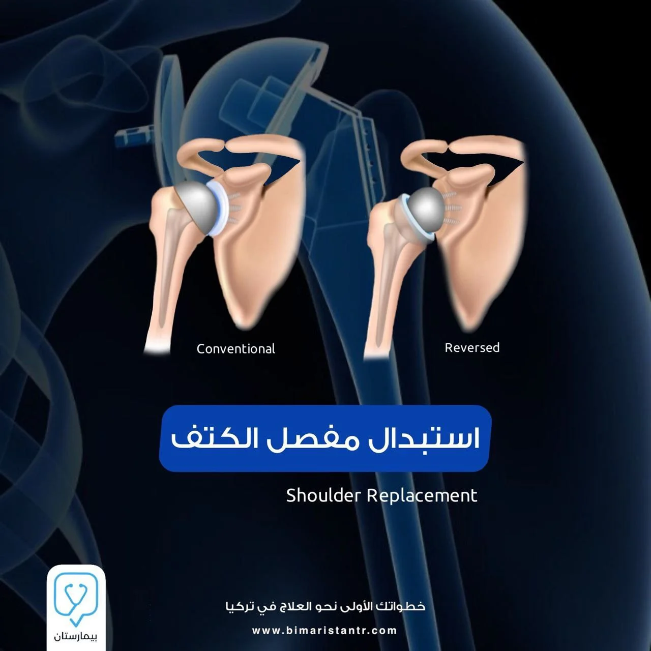 Shoulder-joint replacement