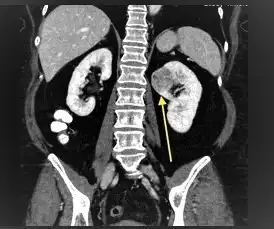 Magnetic resonance imaging (MRI) renal mass
