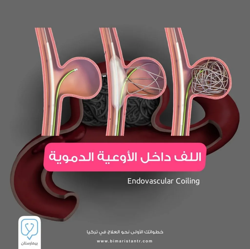Endovascular coiling - treatment of brain aneurysms
