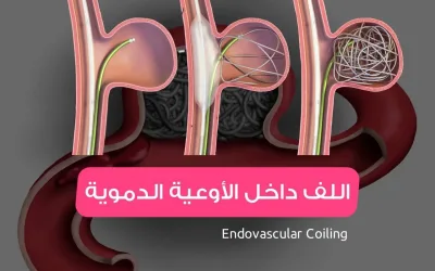 Endovascular coiling - treatment of brain aneurysms