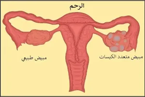 Normal and polycystic ovary