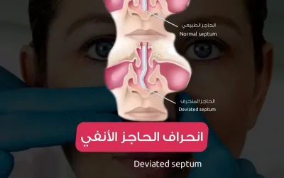 Deviated septum surgery (septoplasty)
