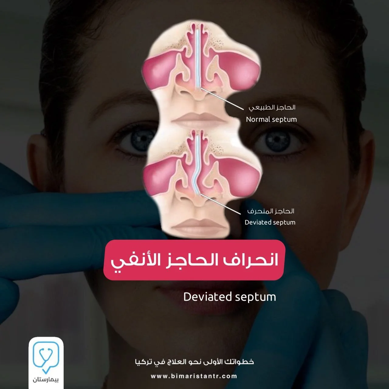 deviation of the nasal septum