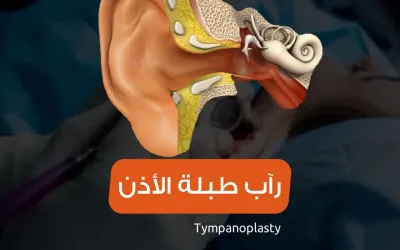 timpanoplasti - timpanoplasti ameliyatı