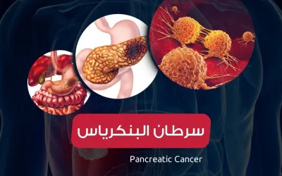 سرطان البنكرياس-أعراض و علامات وطرق العلاج