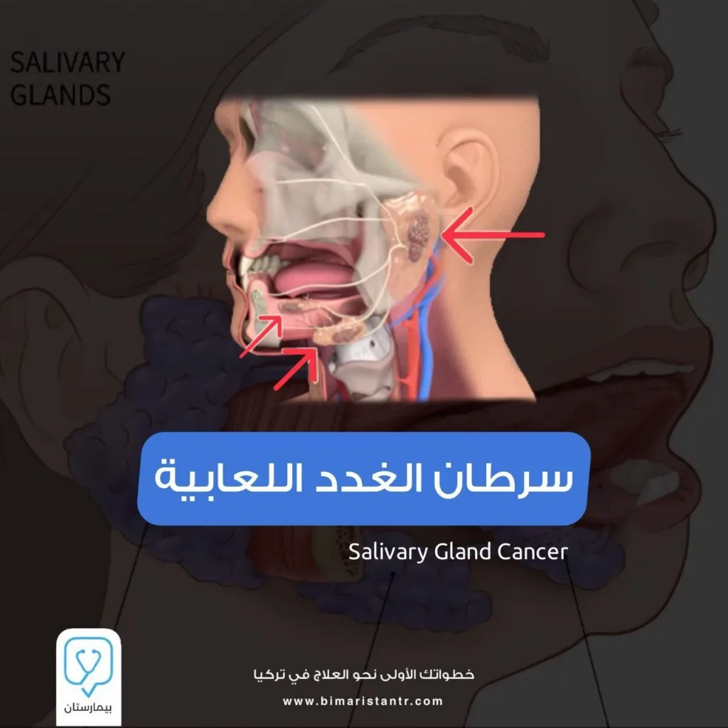 Salivary gland cancer symptoms and treatment in Turkey