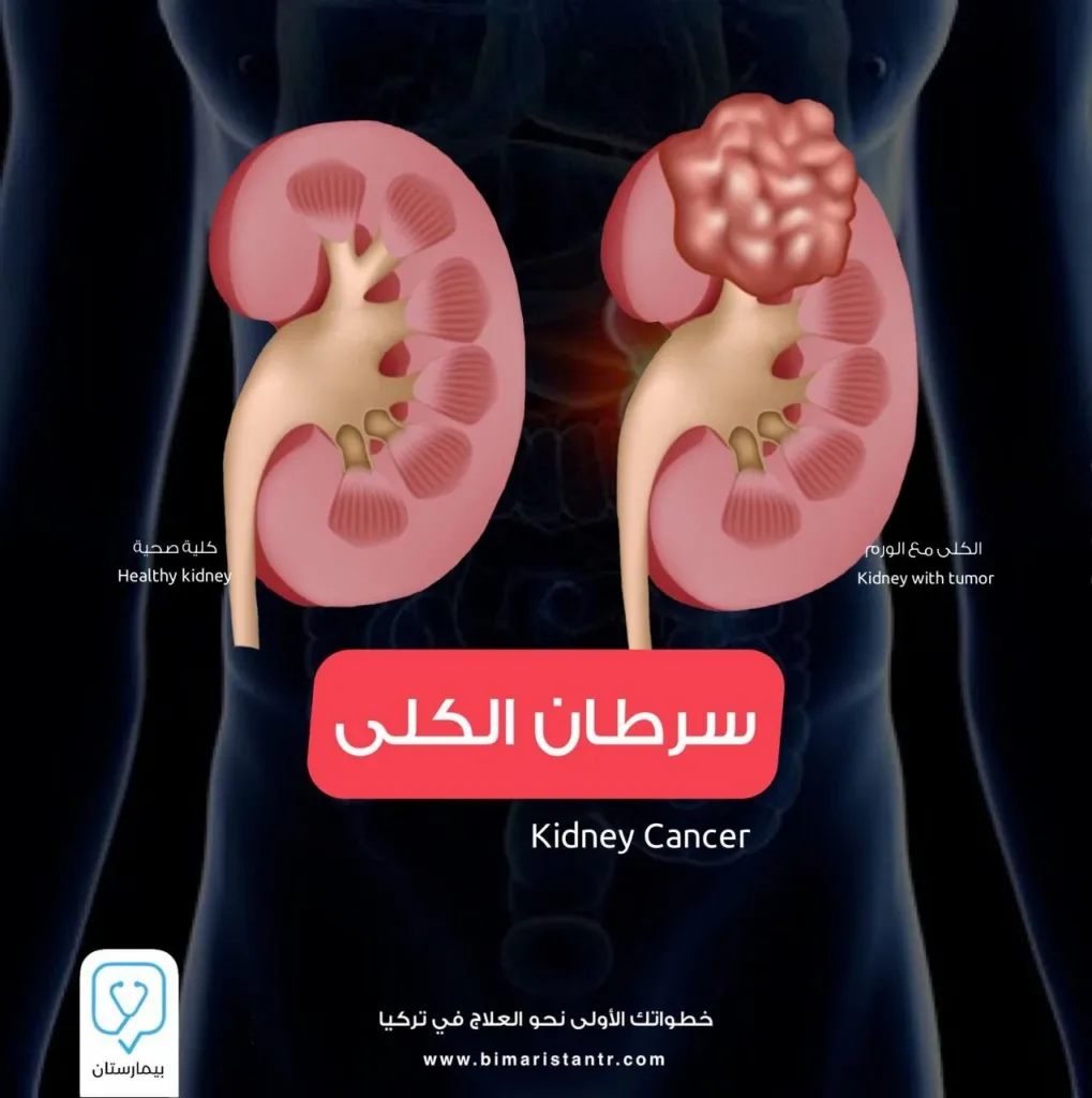 Kidney cancer in Turkey