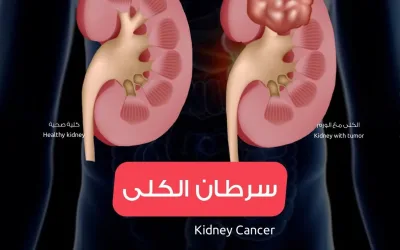 Kidney cancer symptoms, causes and treatment