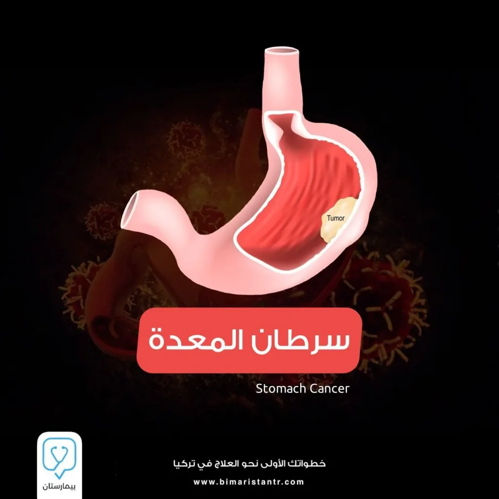 سرطان المعدة stomach cancer - الأعراض وطرق العلاج في تركيا
