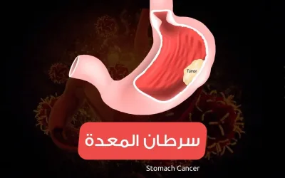 سرطان المعدة stomach cancer -الأعراض وطرق العلاج في تركيا