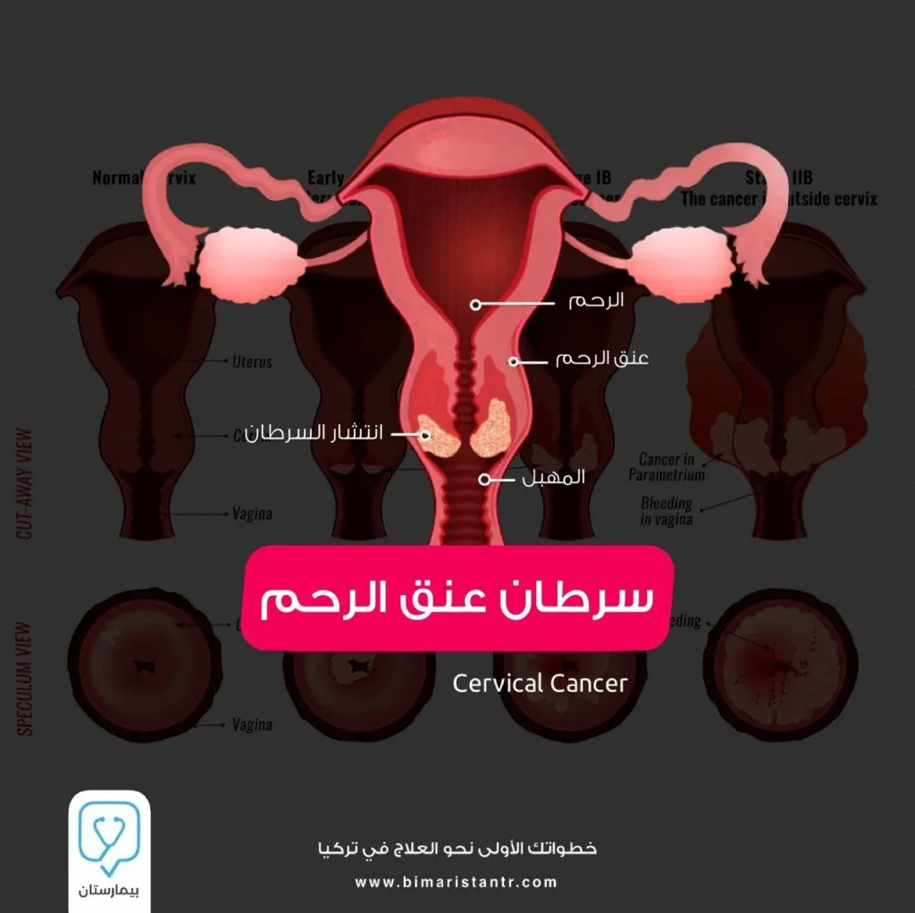 سرطان عنق الرحم