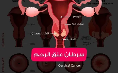 Cervical cancer - symptoms, causes, prevention and treatment
