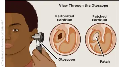 Otoskopla yapılan inceleme ve iki fotoğrafta yamalı bir kulak ve delinmiş bir kulak görülüyor