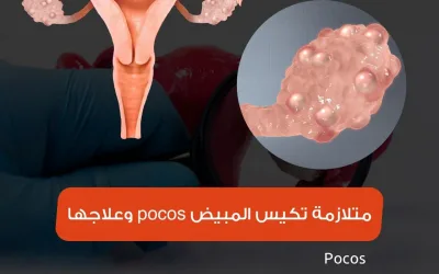 متلازمة تكيس المبيض pcos وعلاجها في تركيا