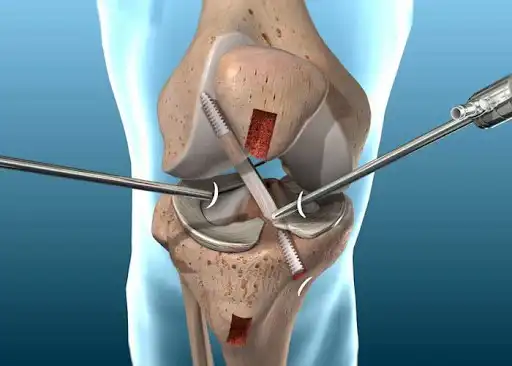 Laparoscopic treatment of anterior cruciate ligament rupture