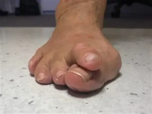 أصابع القدم المطرقية