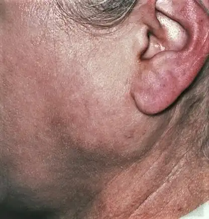 Parotis bezinde bir tümörün varlığını gösterebilecek kulağın altında ve önünde bir şişlik fark ediyoruz.